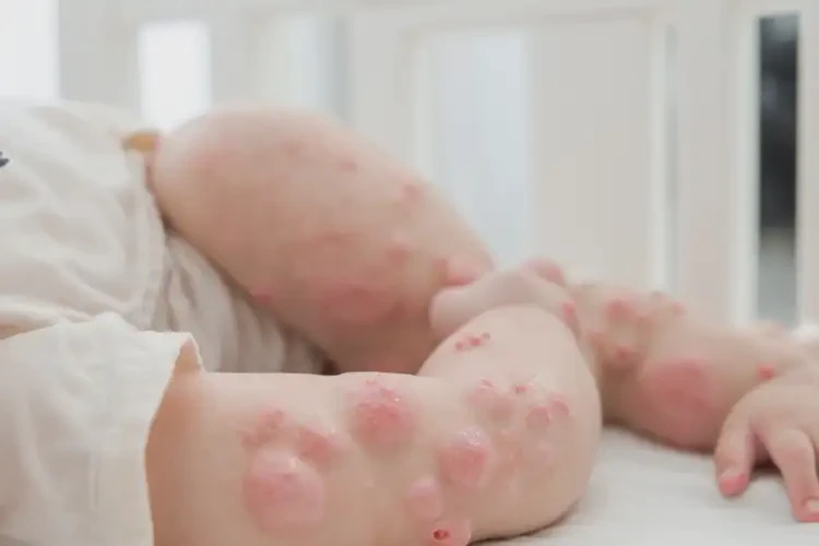 幼兒屁股偶爾長(zhǎng)濕疹可不可以根治(圖4)