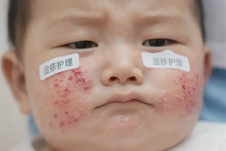 小孩肚子長濕疹可不可以徹底自愈(圖4)