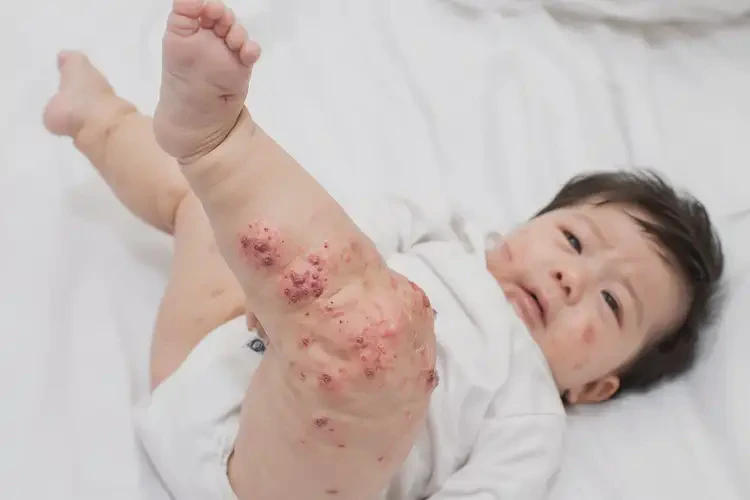 婴儿小腿上偶尔长湿疹可以彻底自愈吗(图3)