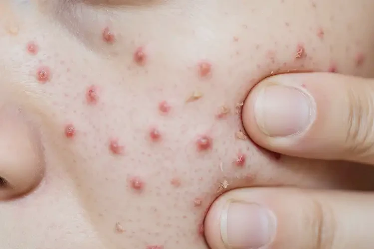 小學(xué)生大腿經(jīng)常起濕疹可不可以根治(圖4)