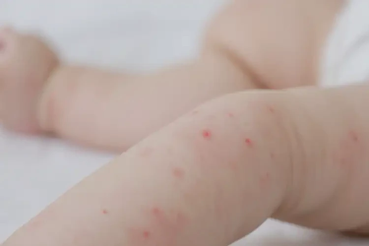 嬰兒手臂偶爾長濕疹可以治好嗎(圖4)