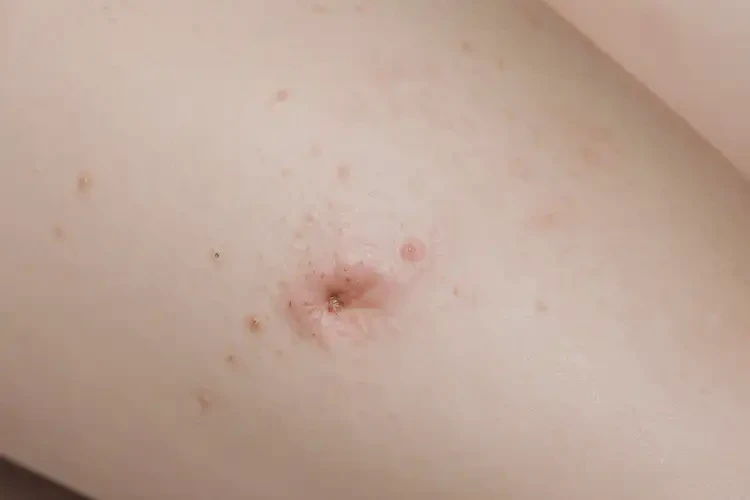 女人大腿容易起濕疹可不可以根治(圖4)