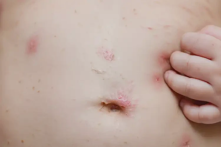 嬰兒肚子上偶爾長濕疹可以治好嗎(圖4)