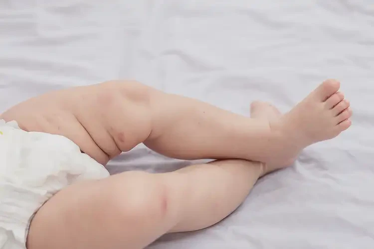 婴儿小腿上偶尔长湿疹可以彻底自愈吗(图1)