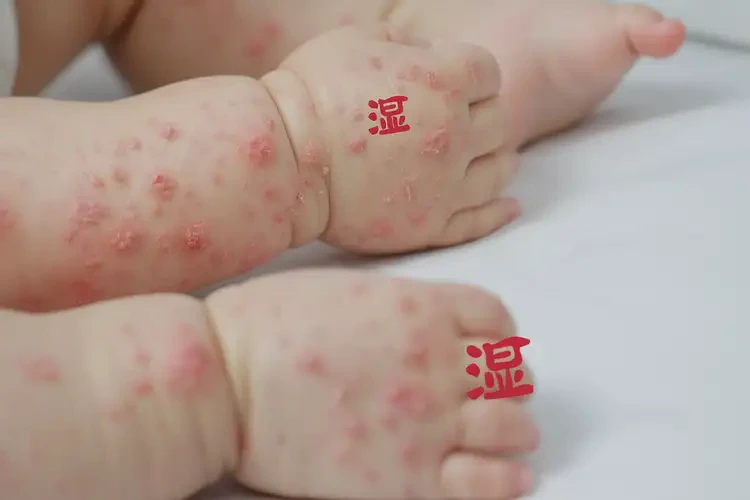 幼兒四肢容易起濕疹能徹底自愈嗎(圖4)