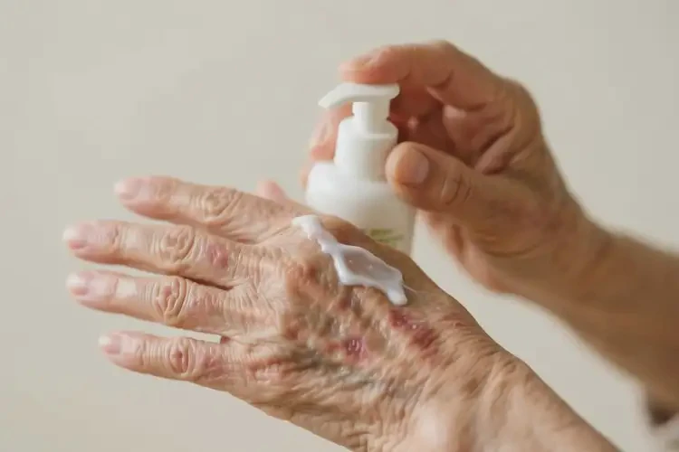 高齡老人手上偶爾長濕疹能不能根治(圖1)