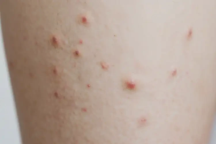 女人小腿上偶爾起濕疹可不可以根治(圖4)