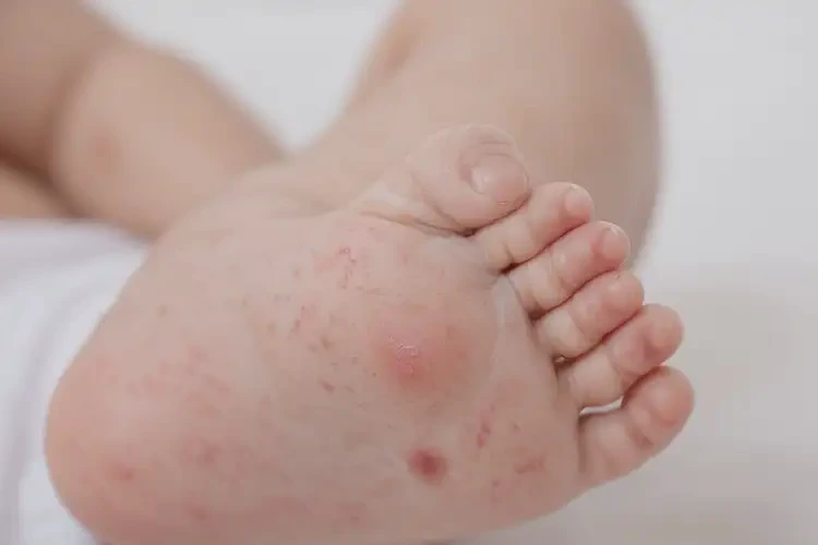 婴儿小腿上有湿疹能彻底自愈吗(图4)