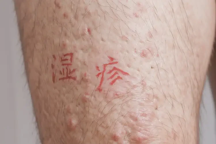 男生大腿偶爾長濕疹可不可以根治(圖4)