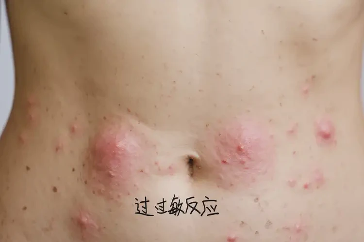 女性肚子起濕疹可不可以根治(圖4)