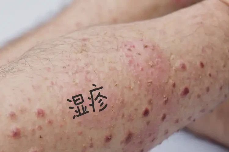 男人四肢偶爾長濕疹能不能根治(圖4)