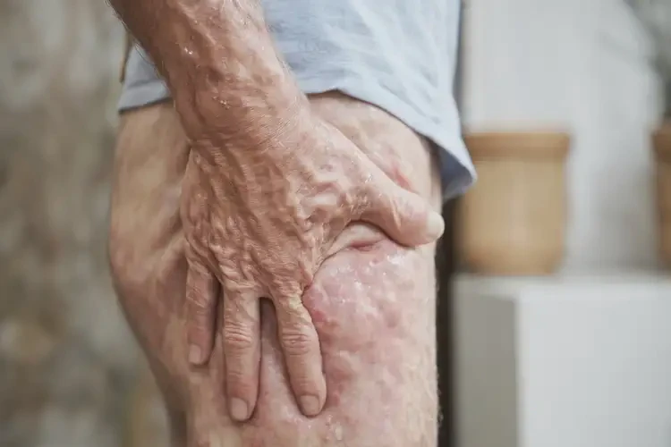 老人肛周出濕疹不管它會自己痊愈嗎(圖4)