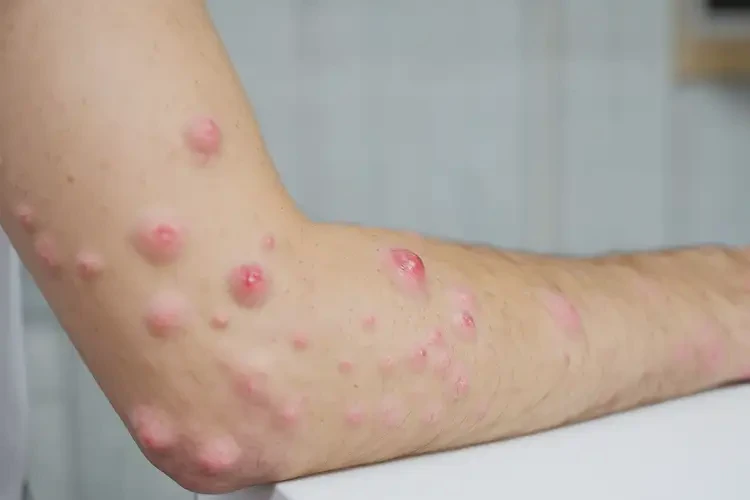 大學(xué)生手臂有濕疹不管它會(huì)自己好嗎(圖4)