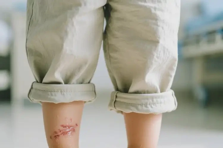 小孩小腿上出濕疹可不可以根治(圖1)