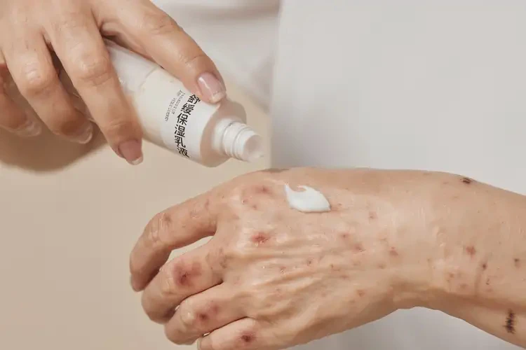 女性手上長濕疹可不可以根治(圖3)
