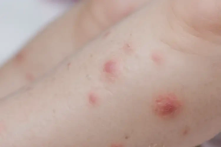 兒童小腿上偶爾起濕疹可不可以根治(圖4)