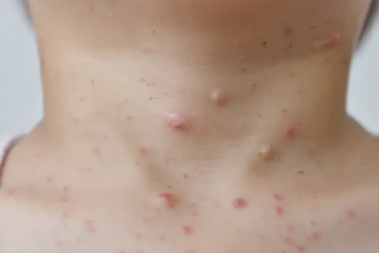 儿童脖子上经常长湿疹可不可以根治(图4)