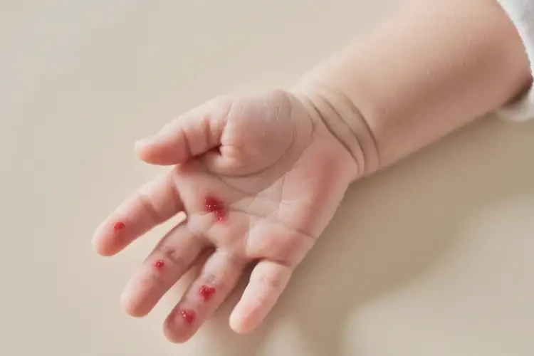 新生儿手上偶尔长湿疹可不可以根治(图1)
