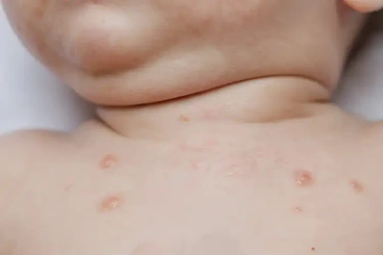 孩子脖子起濕疹可不可以根治(圖4)