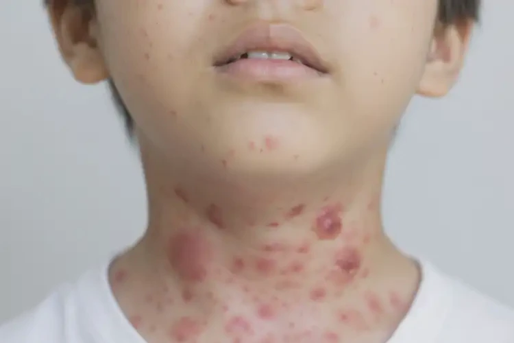 中學生脖子經(jīng)常起濕疹可不可以根治(圖4)