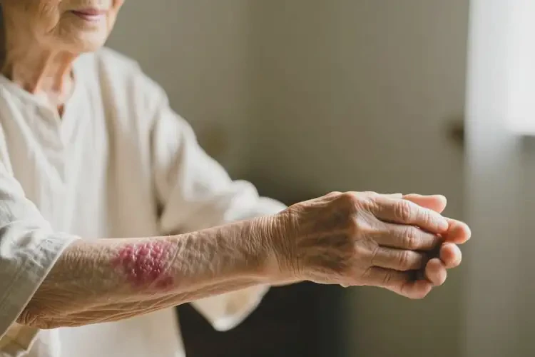 高齡老人手臂上長濕疹可不可以根治(圖1)