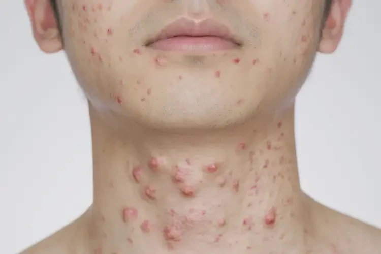 男生脖子出现湿疹可不可以根治(图4)