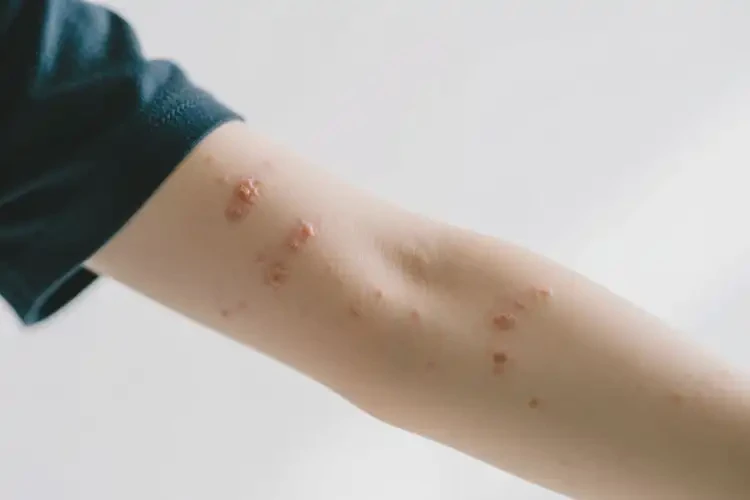 大學(xué)生手臂上偶爾長濕疹可不可以根治(圖4)