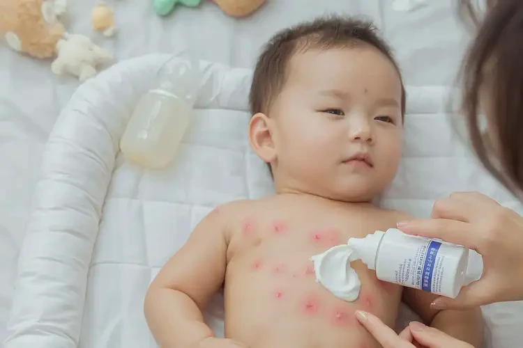嬰兒全身容易起濕疹不管它會(huì)自己痊愈嗎(圖4)