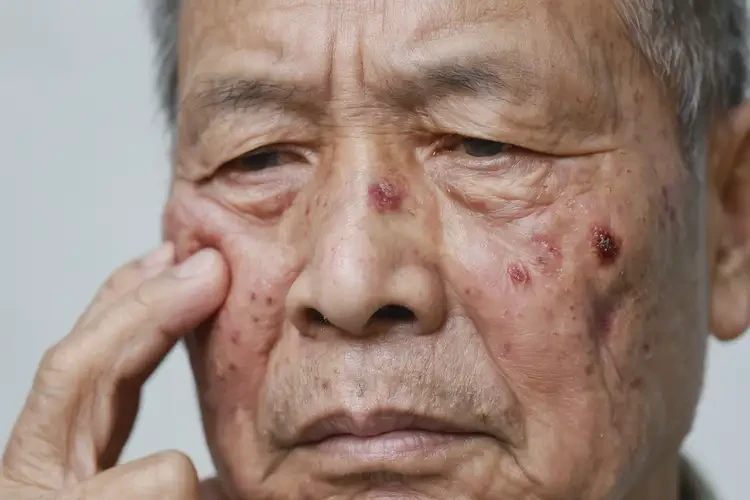 老年人面部出现湿疹不管它会自己痊愈吗(图4)