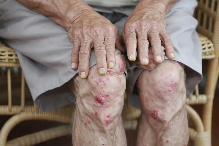 老人大腿上偶爾起濕疹能夠徹底治愈嗎(圖4)