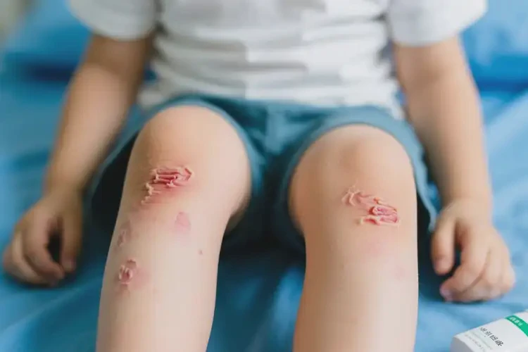 孩子四肢出現(xiàn)濕疹可不可以根治(圖3)