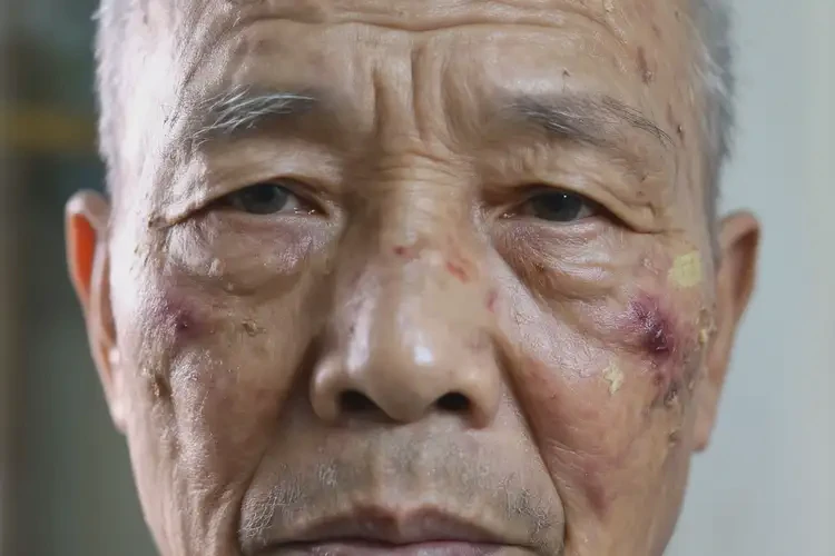 老人面部容易起濕疹可不可以根治(圖4)