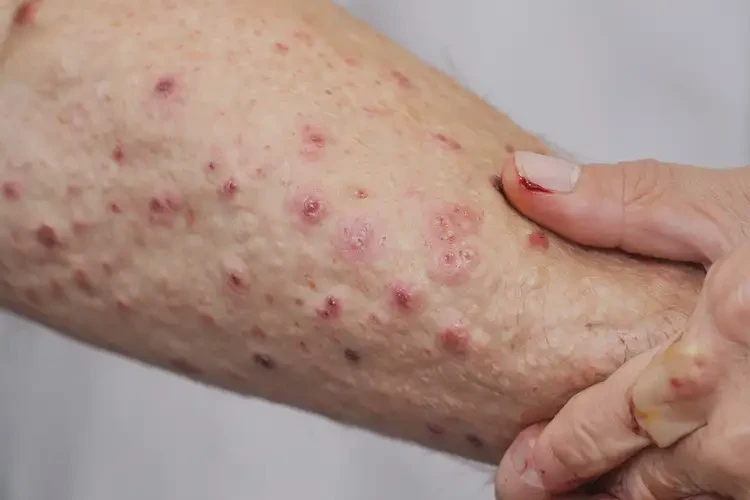 老年人身上起濕疹可不可以根治(圖4)