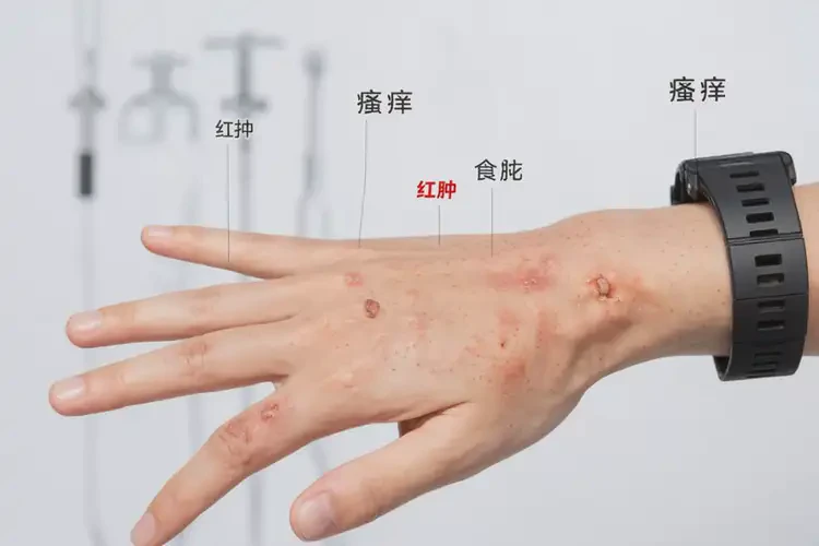 青年人手上經(jīng)常起濕疹可不可以根治(圖4)