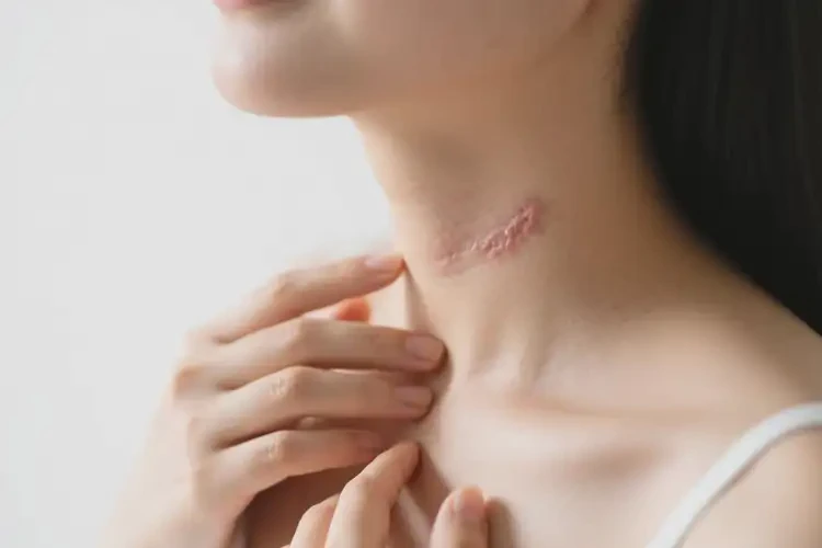 產(chǎn)婦脖子上出濕疹可不可以根治(圖3)