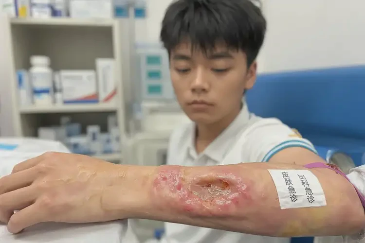 大學(xué)生手臂上出現(xiàn)濕疹不管它會自己痊愈嗎(圖2)