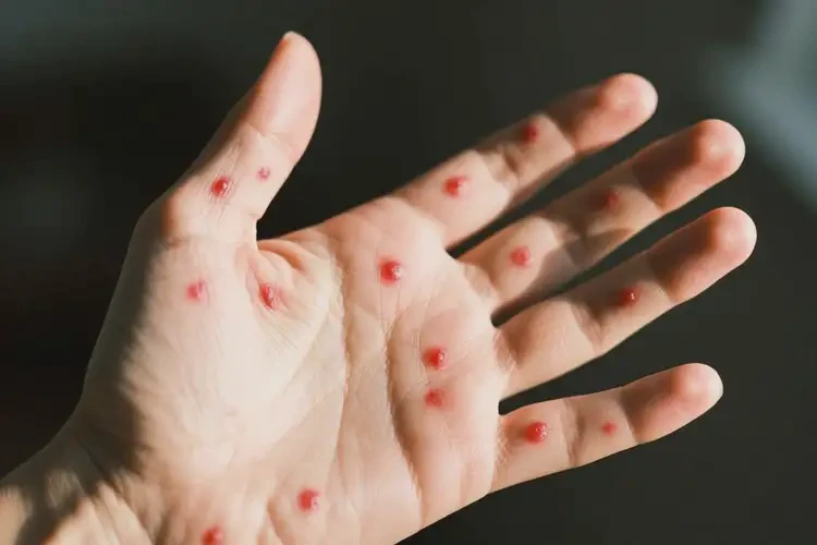 女性手上出现湿疹不管它会自己好吗(图3)