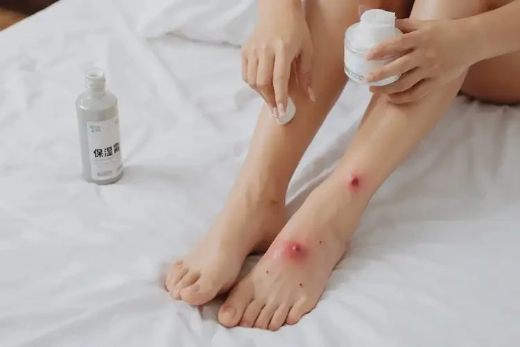 孕婦腳上長濕疹可不可以根治(圖3)