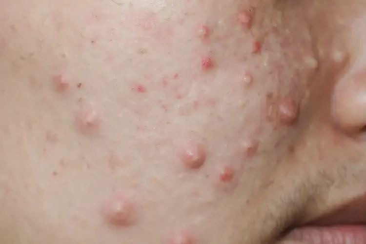 男人屁股上容易起濕疹可不可以根治(圖4)