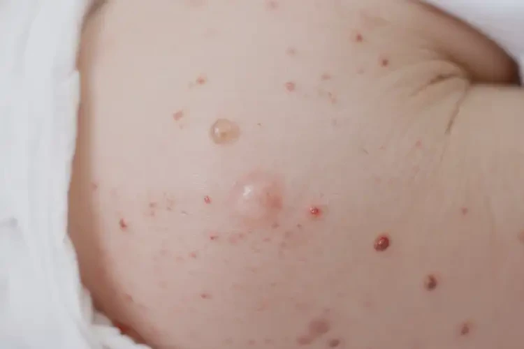 新生兒屁股上出濕疹可不可以徹底自愈(圖4)