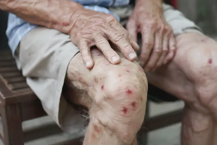 老人大腿上偶爾起濕疹可不可以根治(圖4)