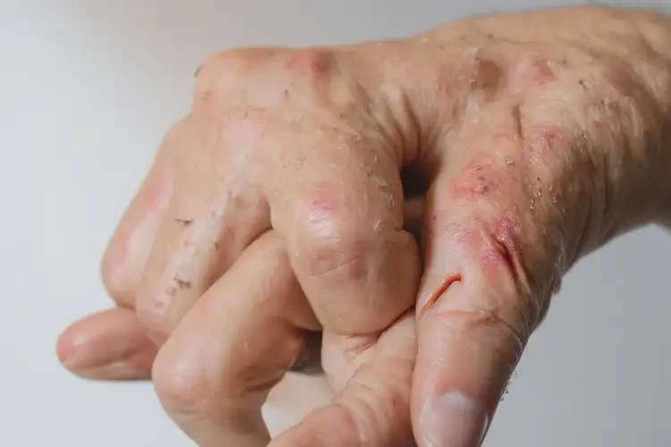 女性手上長濕疹可不可以根治(圖4)