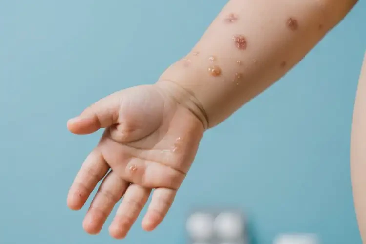 小儿手臂上偶尔起湿疹可不可以根治(图2)