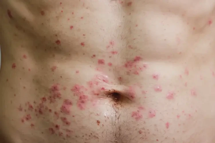 男性肚子偶尔长湿疹能彻底自愈吗(图3)