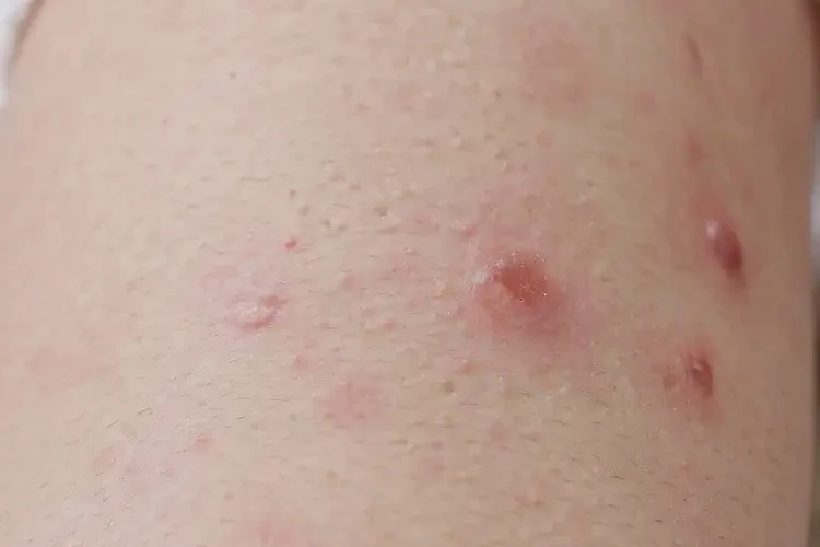 小兒小腿上長濕疹可不可以根治(圖4)