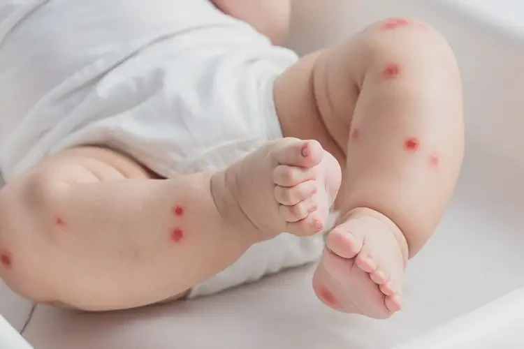 婴儿小腿上偶尔长湿疹可以彻底自愈吗(图4)