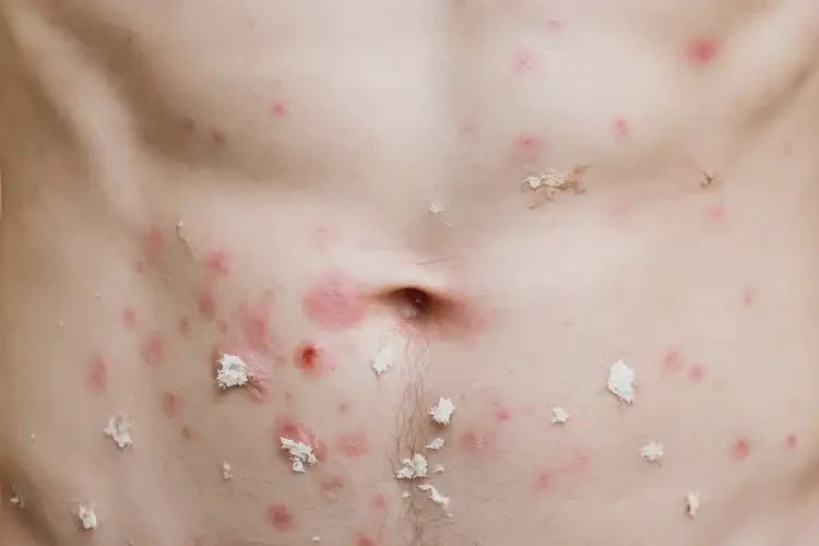 青少年肚子上經(jīng)常長濕疹可不可以根治(圖4)