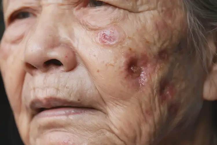 高齡老人臉上出濕疹可不可以根治(圖4)