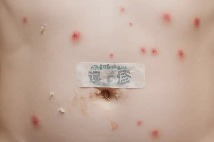 小學(xué)生肚子上經(jīng)常起濕疹可不可以根治(圖4)