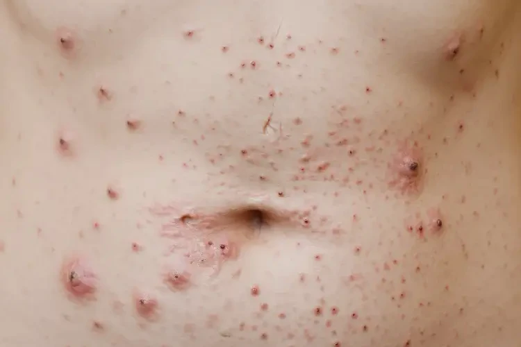 女人肚子上出現(xiàn)濕疹能不能根治(圖4)